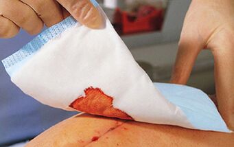 Après une chirurgie d'agrandissement du pénis, il est nécessaire d'appliquer des bandages