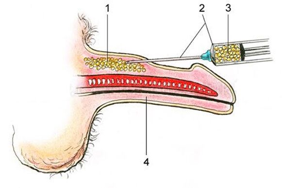 Lipofilling - l'insertion de tissu adipeux dans la tige du pénis