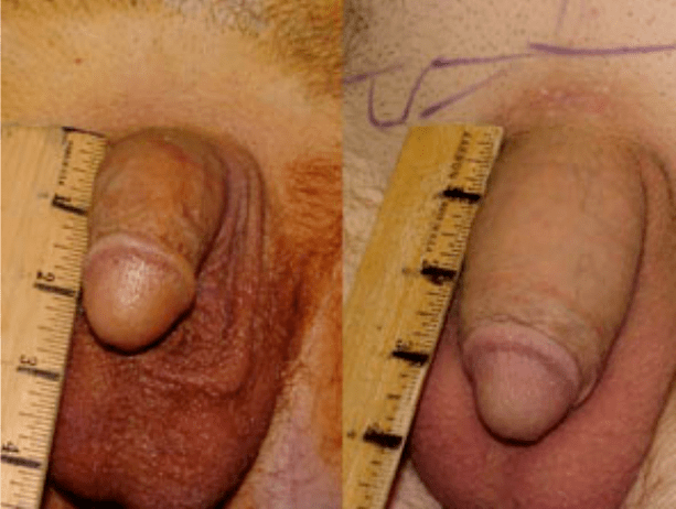 Avant et après lipofilling et implantation de gel