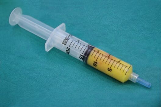 Seringue avec tissu adipeux pour lipofilling